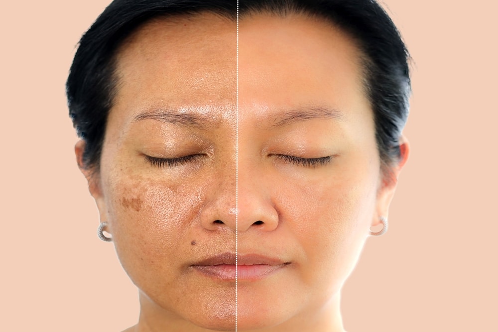 Model's face divided down the middle, melasma patches on one side and clear skin on the other
