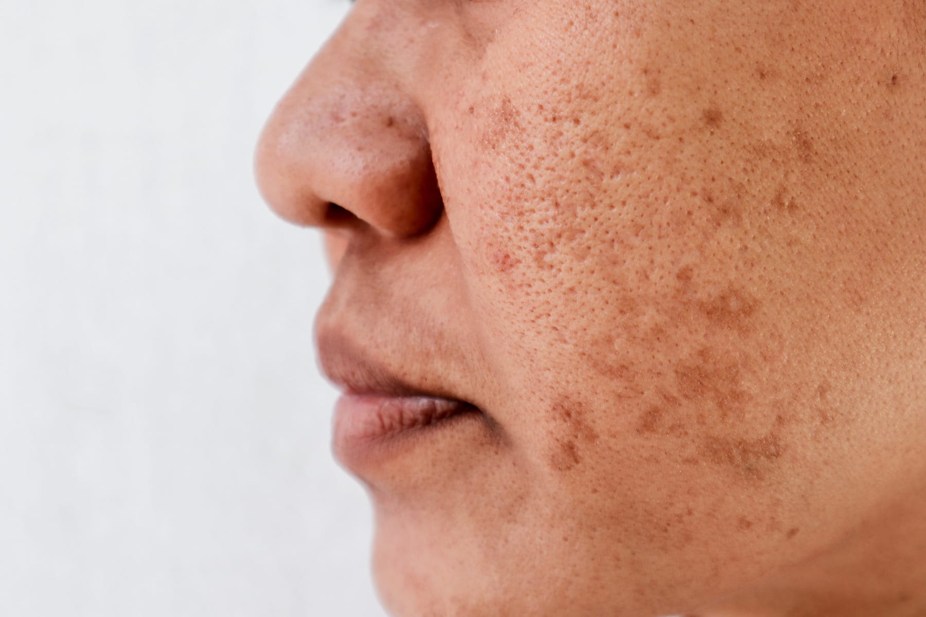 Close-up of a model's cheek and jaw with patches of dark pigmentation