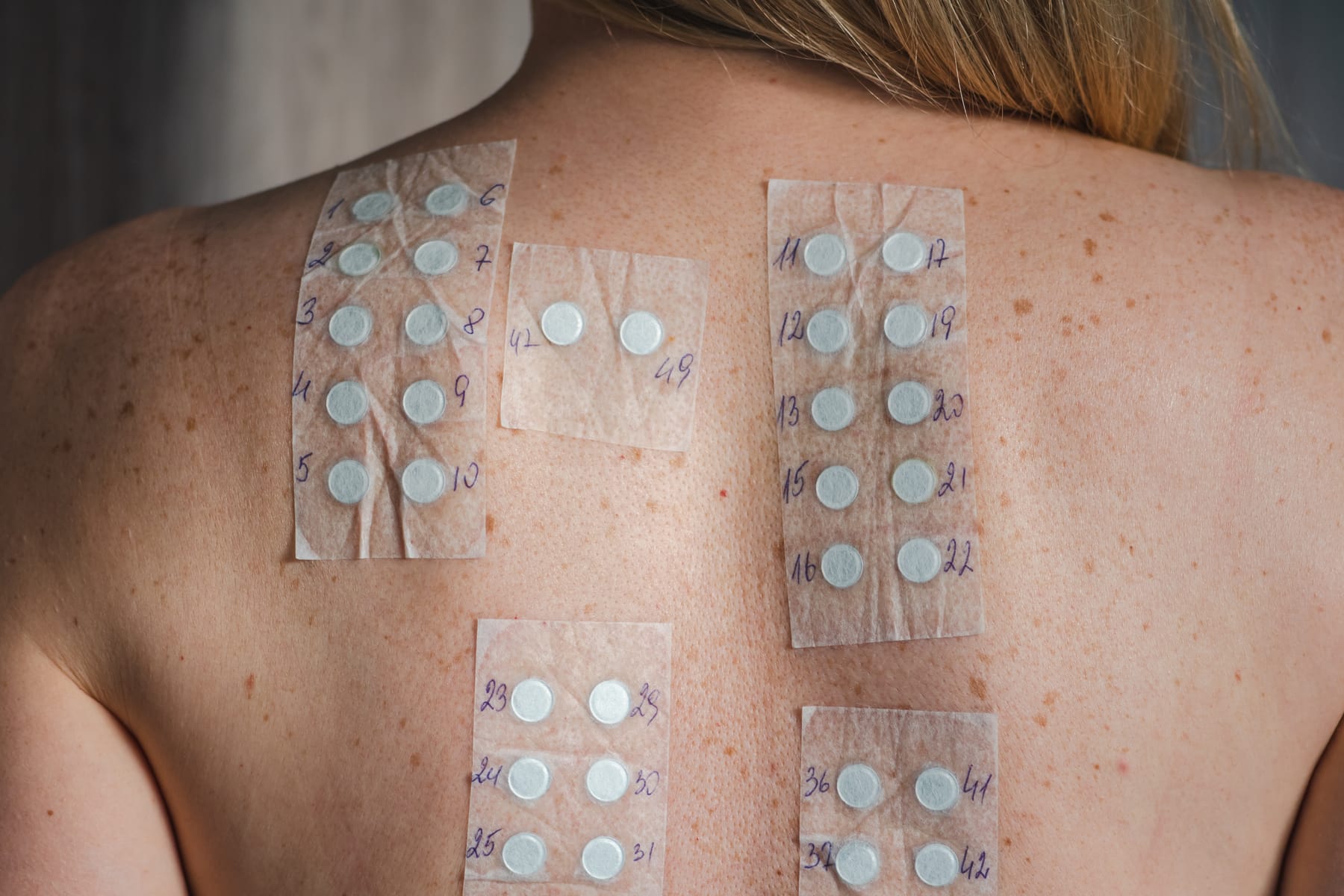 Allergy patch-test strips on the bare shoulder and upper back of a blonde model