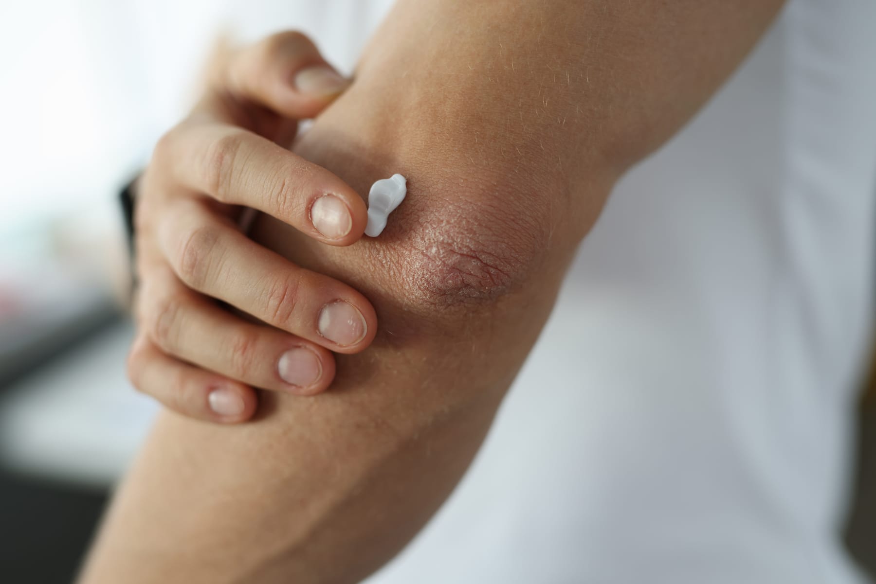 Close-up of cream being applied to dry, irritated skin on an elbow