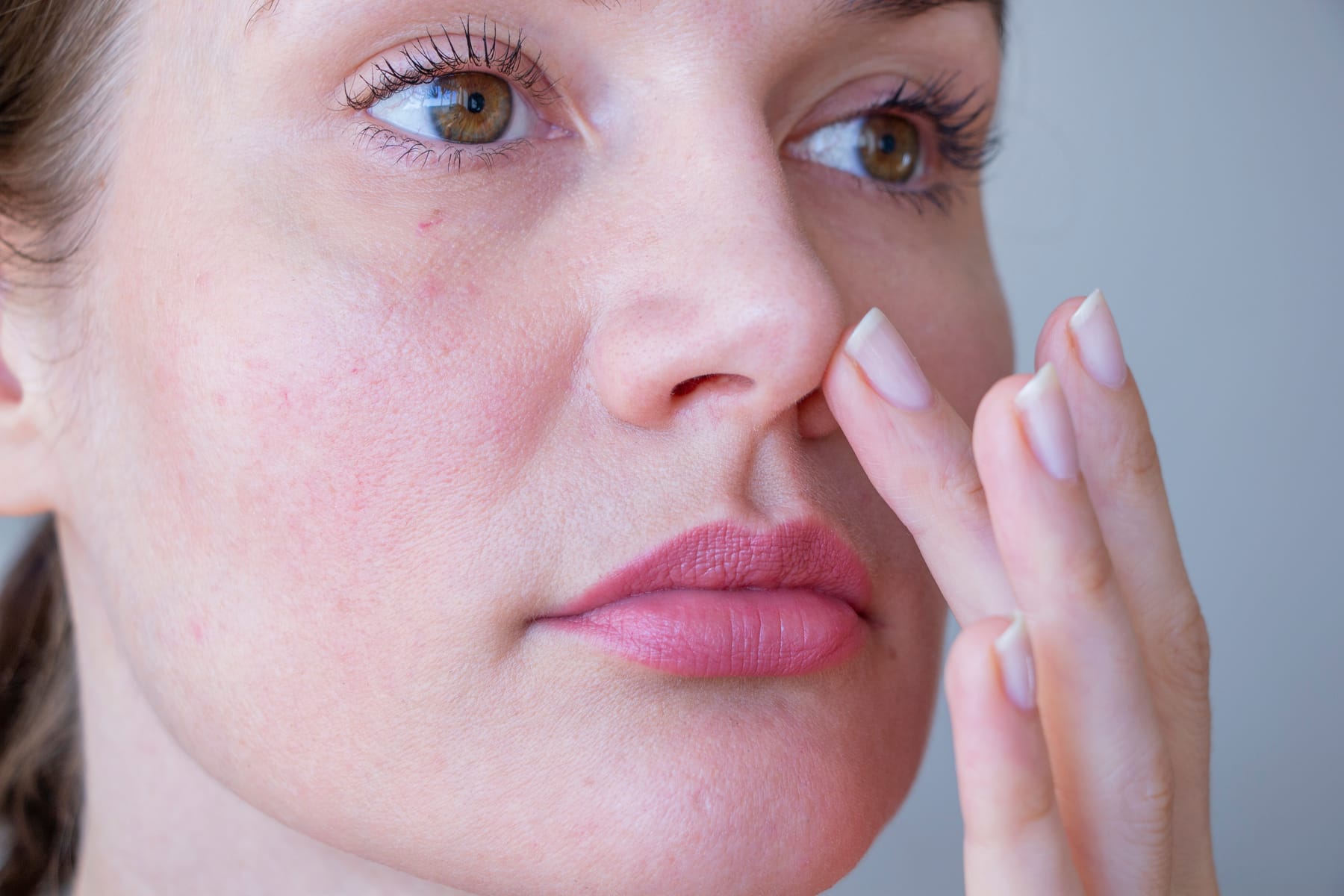 Model with redness across her cheeks, a finger resting beside her nose