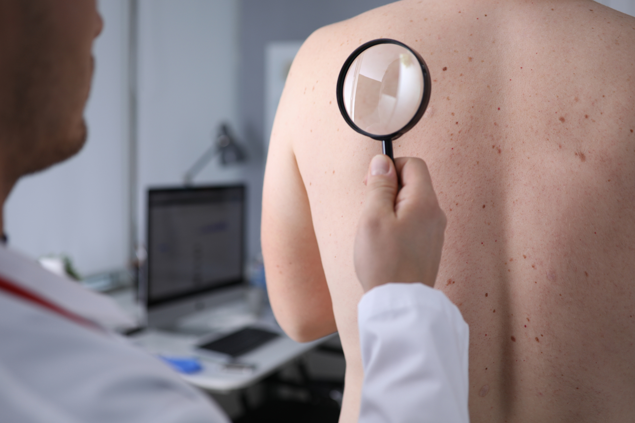 Clinician checking moles on a patient's back with a magnifying glass