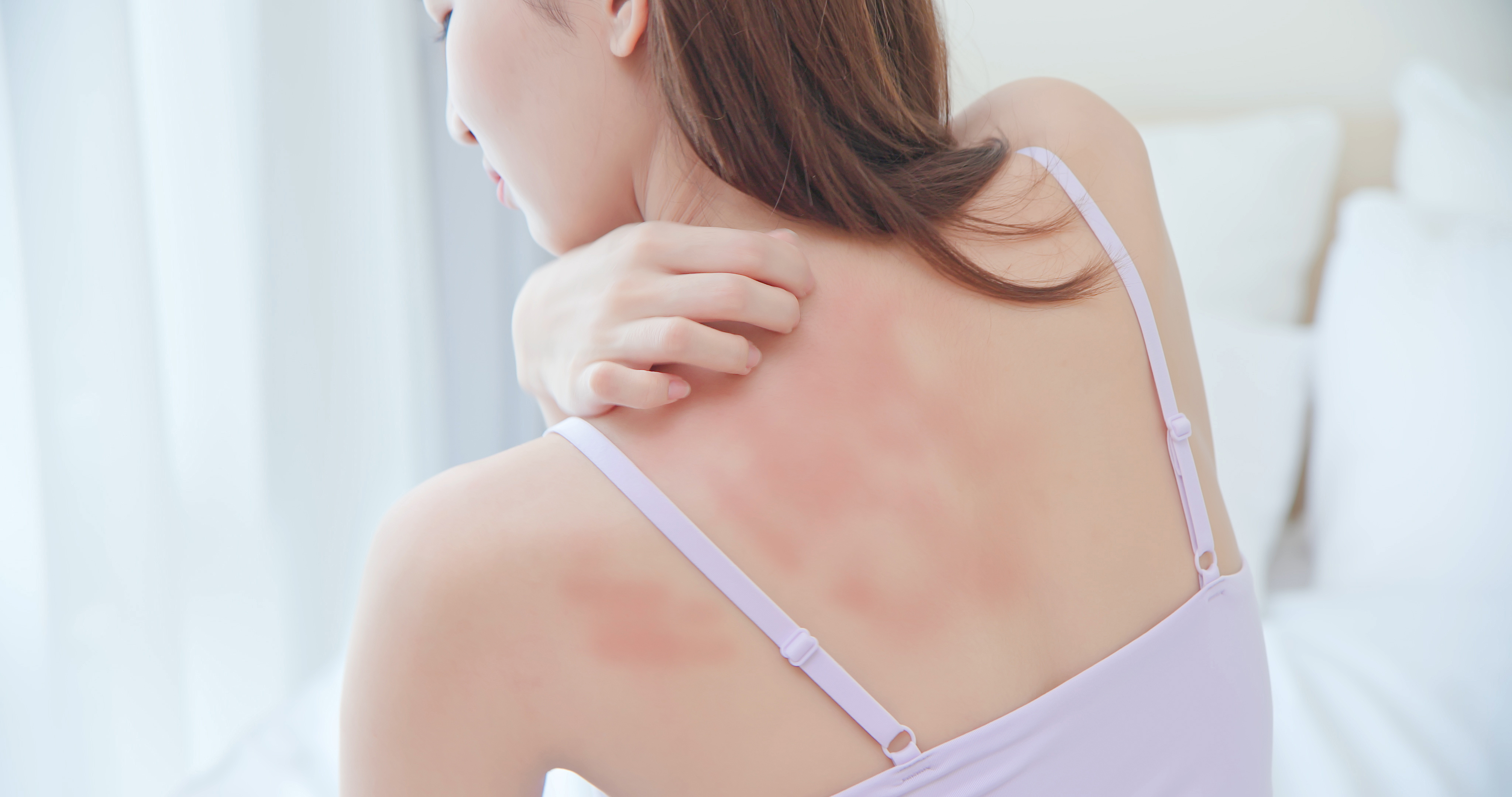Model's bare shoulder and back with a red, irritated rash