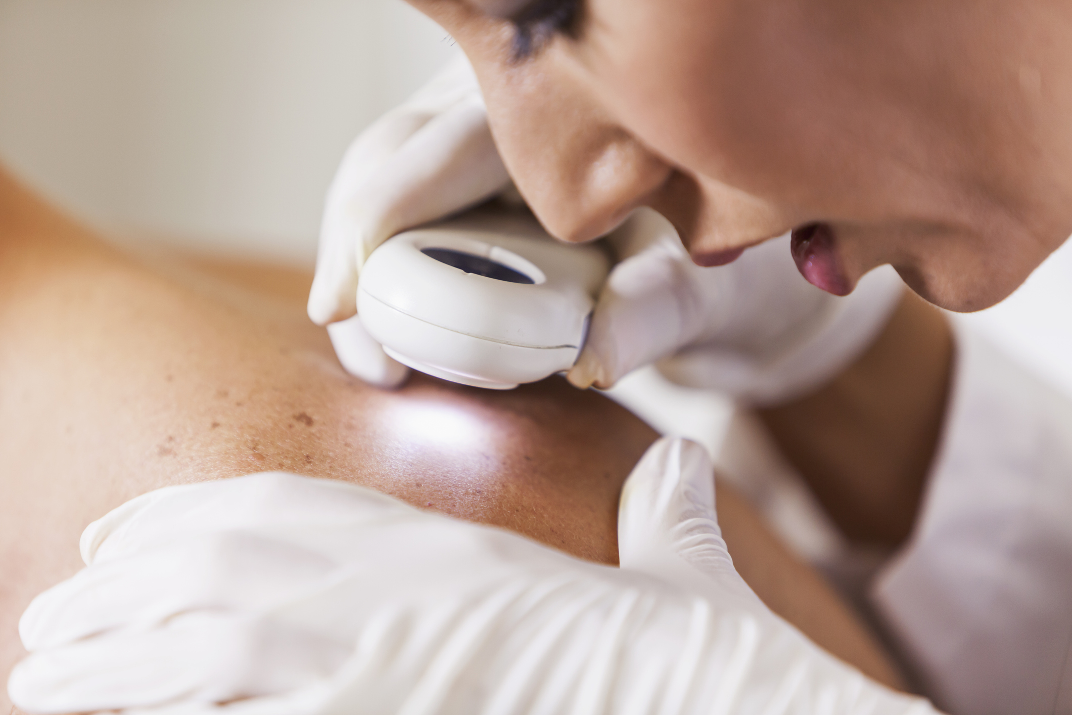 Clinician examining a patient's shoulder skin with a dermatoscope