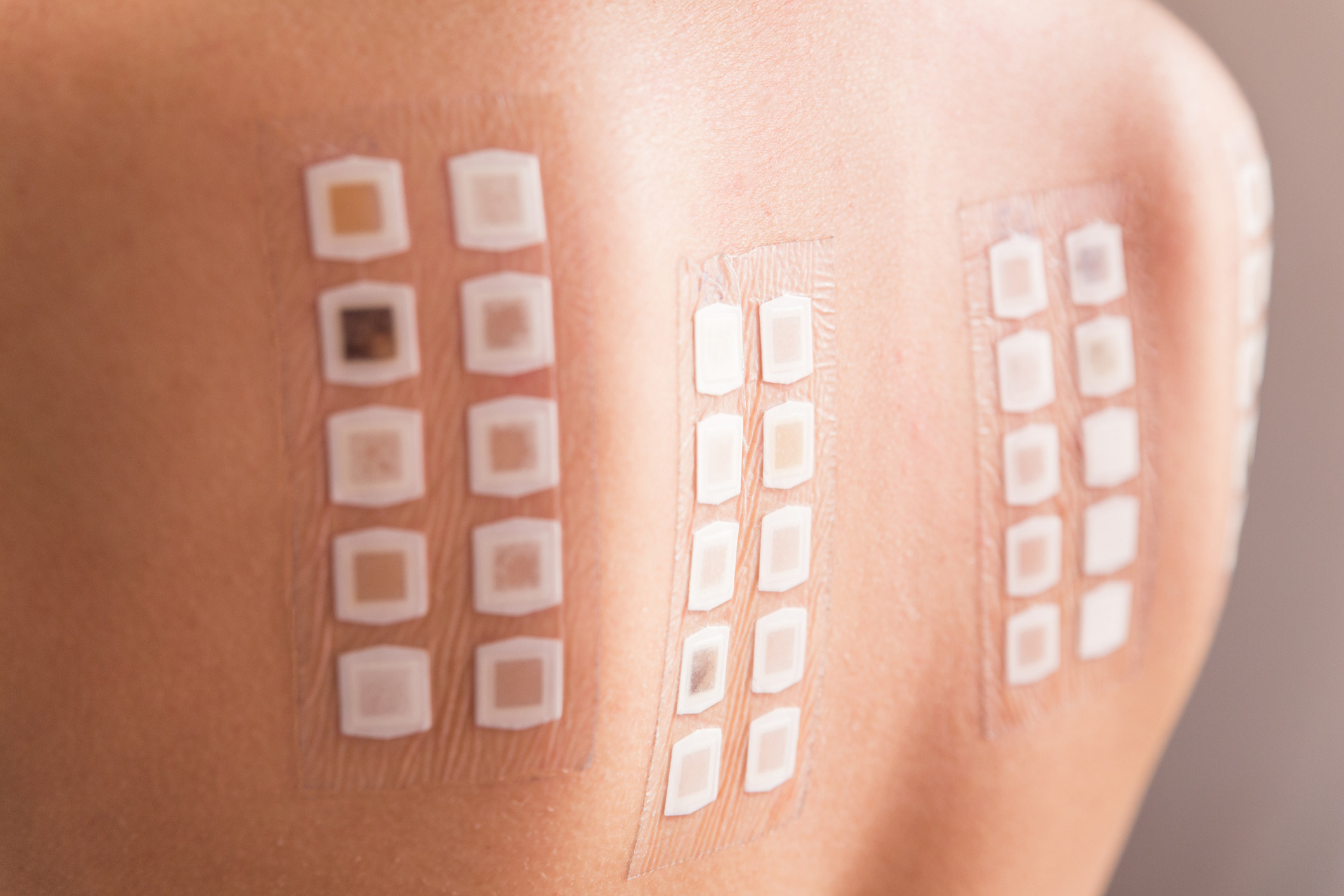 Patch test strips on a patient's back