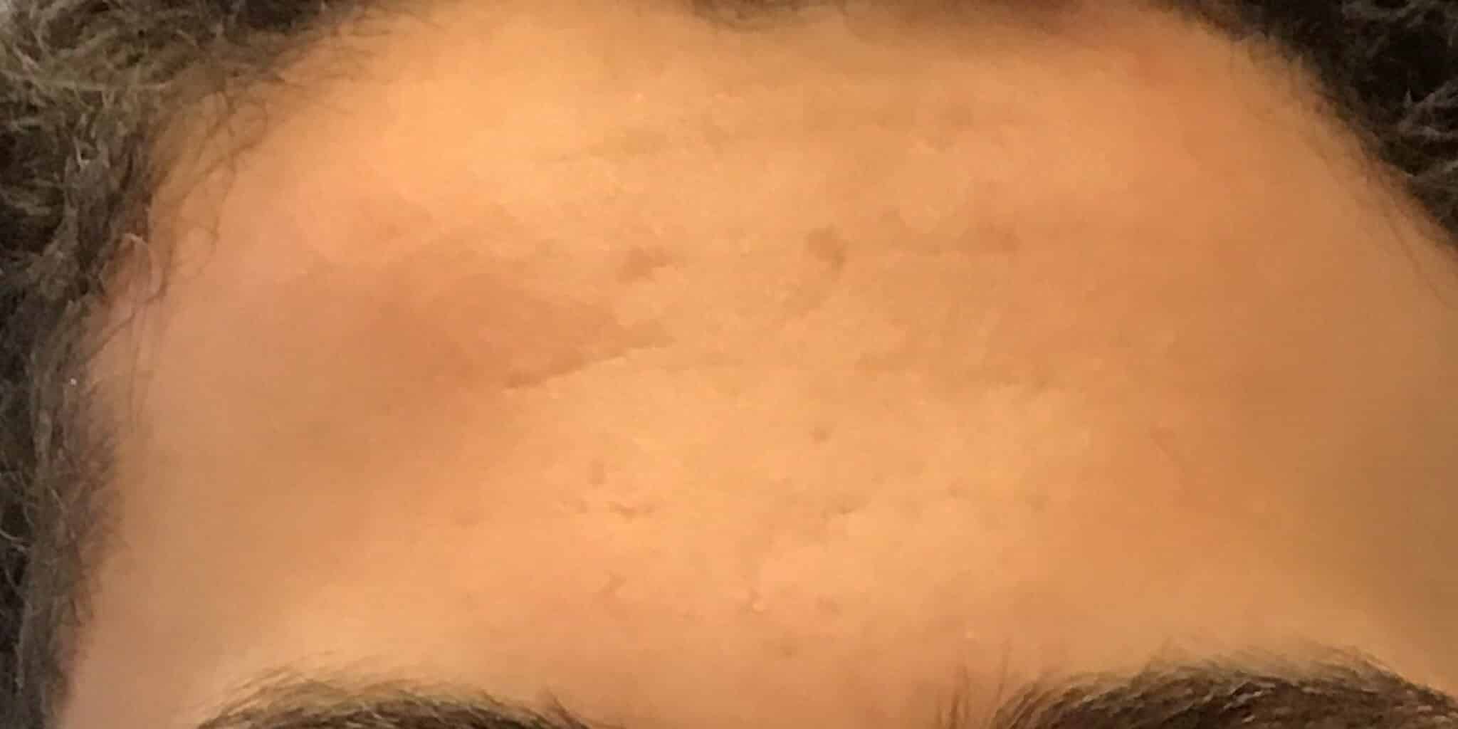 After Image: Acne - front