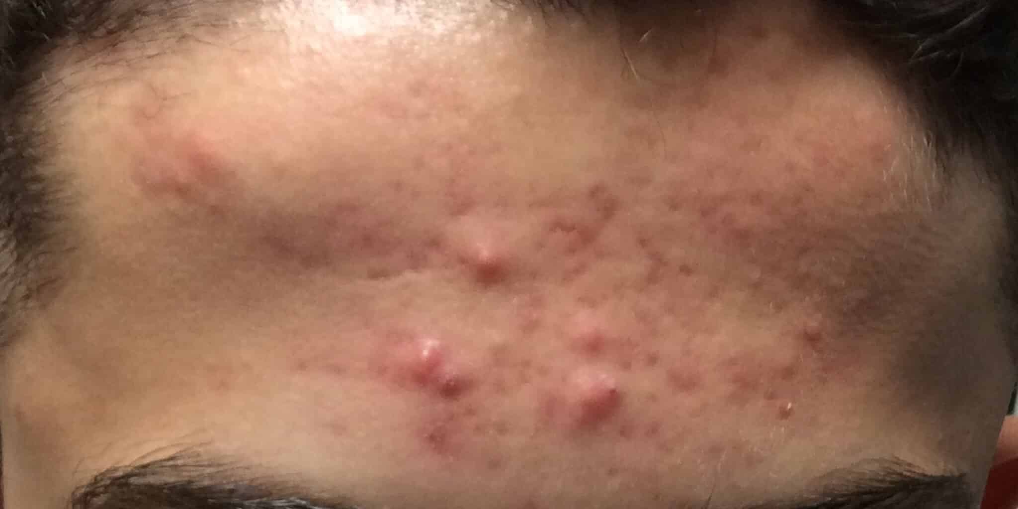Before Image: Acne - front