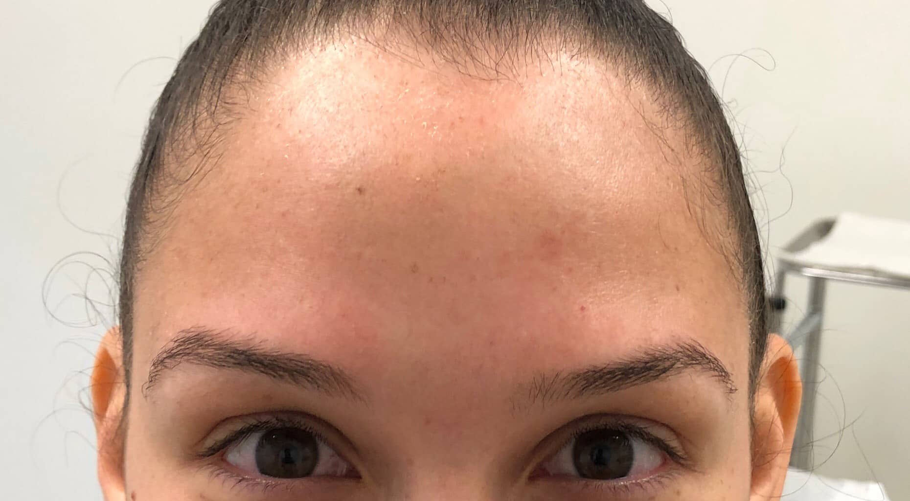 After Image: Botox - front