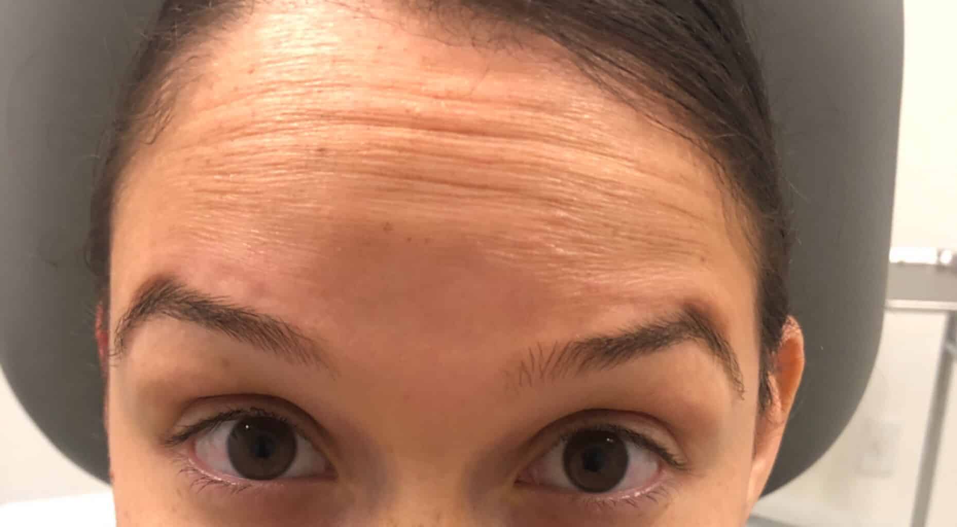 Before Image: Botox - front