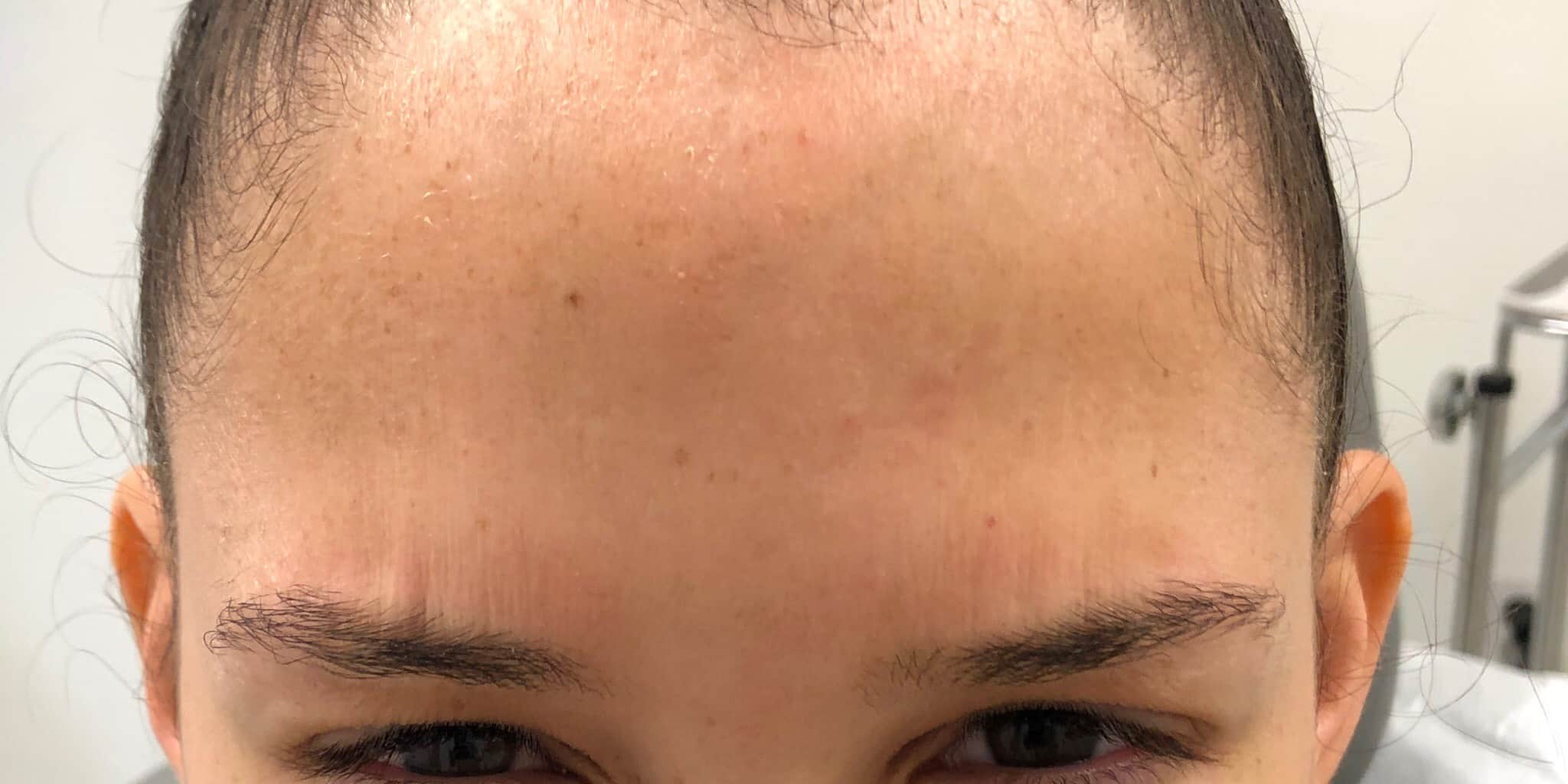 After Image: Glabella - front
