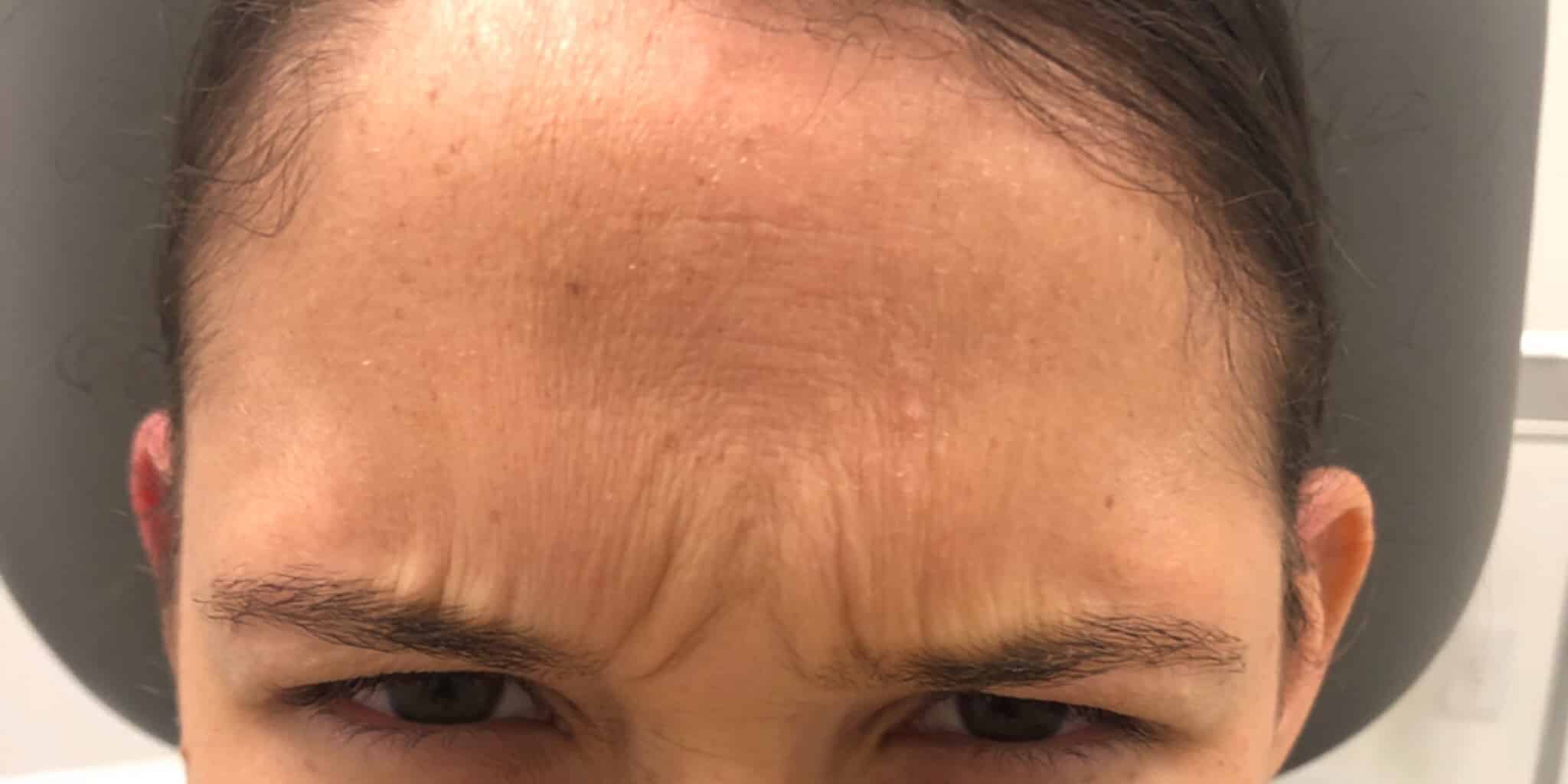 Before Image: Glabella - front