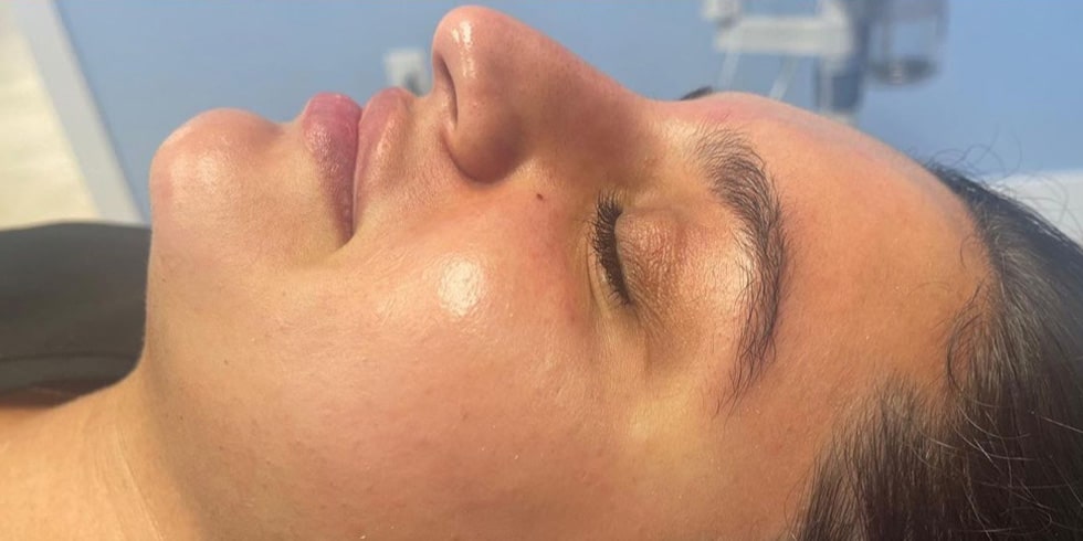 After Image: Hydrafacial - front