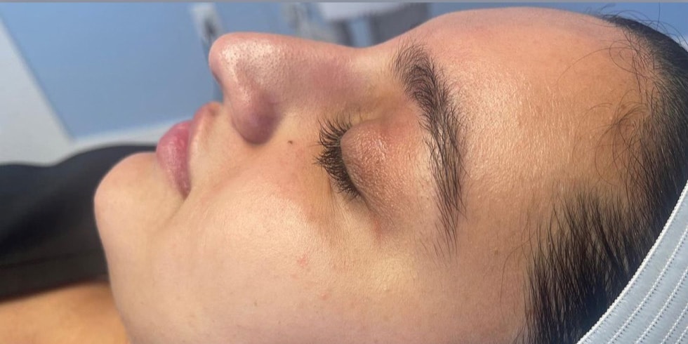 Before Image: Hydrafacial - front