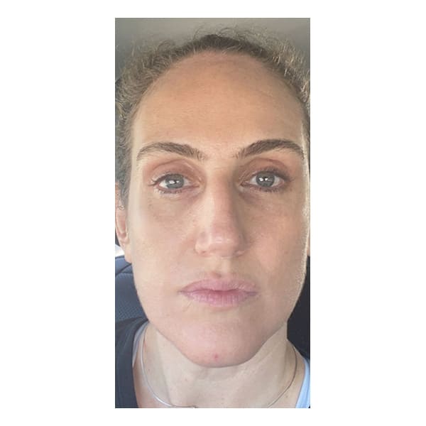 After Image: Lentigines and Brown Spots - front