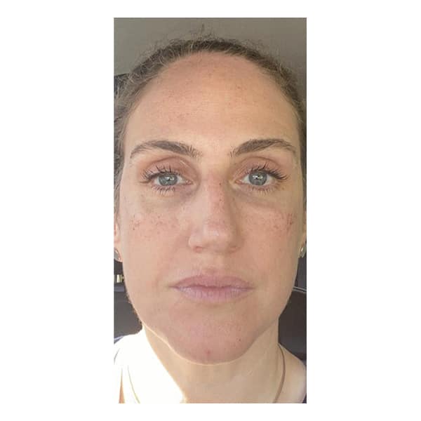 Before Image: Lentigines and Brown Spots - front