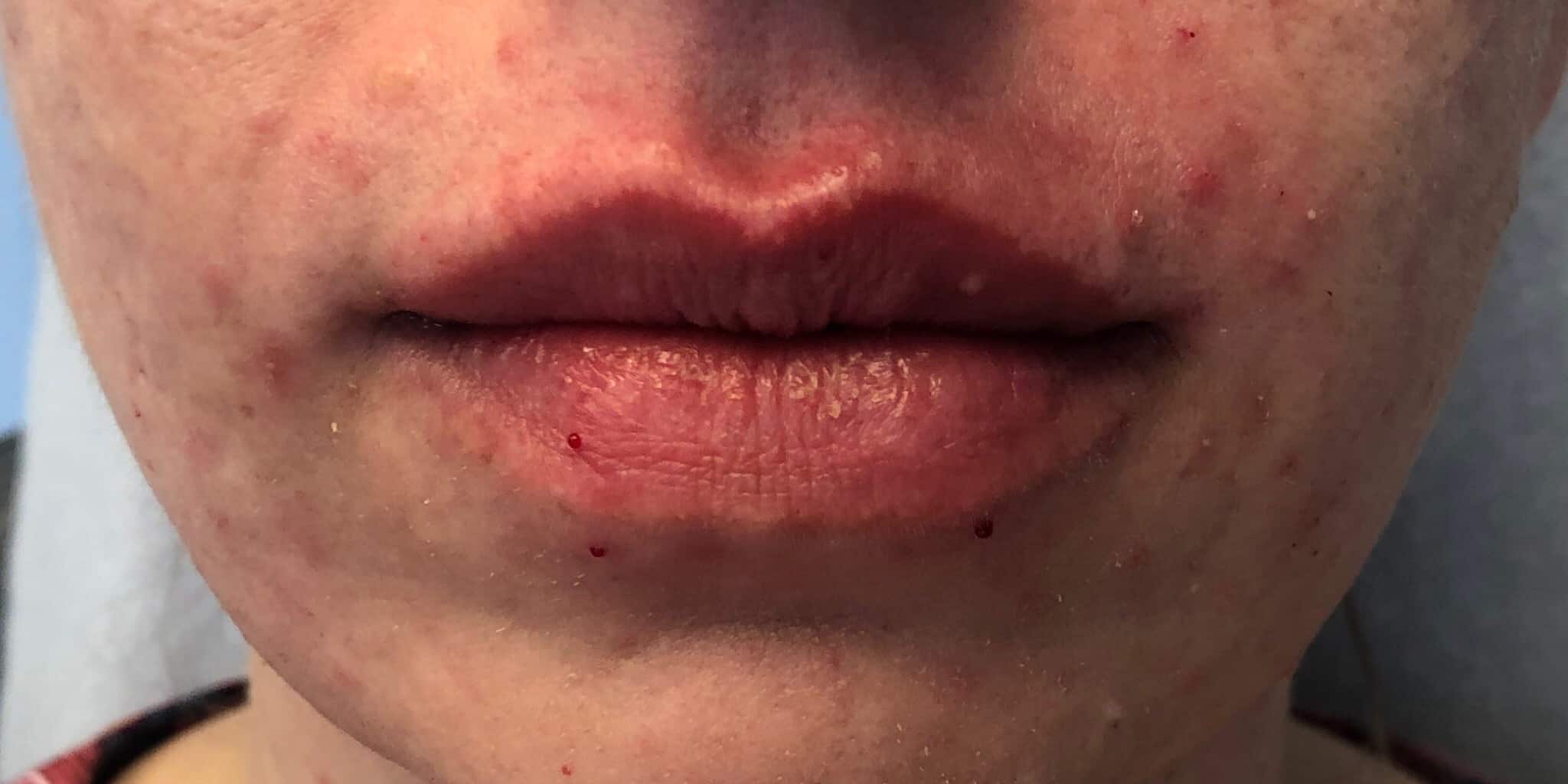 After Image: Lip Filler - front