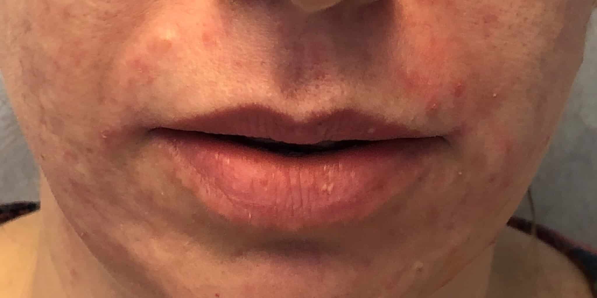 Before Image: Lip Filler - front