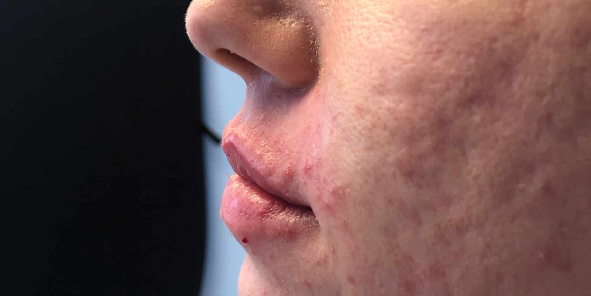 After Image: Lip Filler - left-side