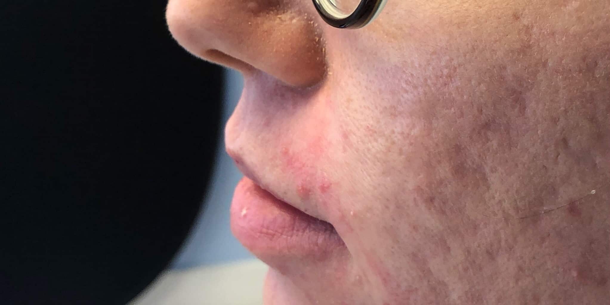 Before Image: Lip Filler - left-side