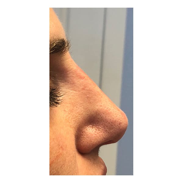After Image: Liquid Rhinoplasty - right-side