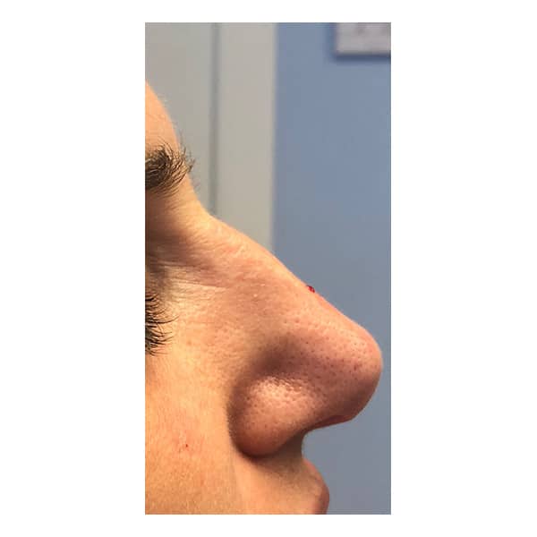 Before Image: Liquid Rhinoplasty - right-side