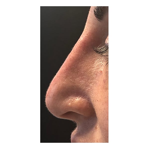 After Image: Liquid Rhinoplasty - left-side