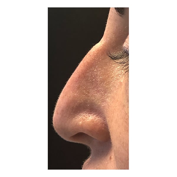 Before Image: Liquid Rhinoplasty - left-side