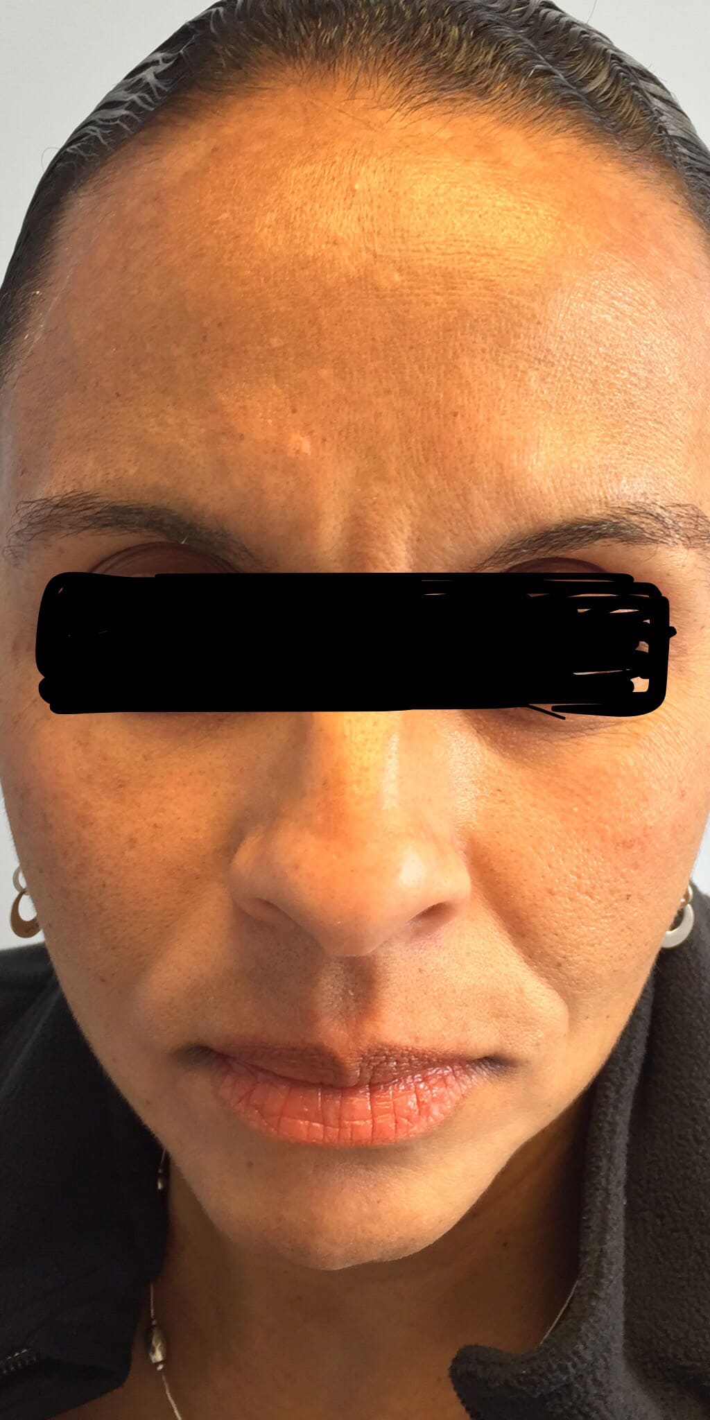 After Image: Melasma - front
