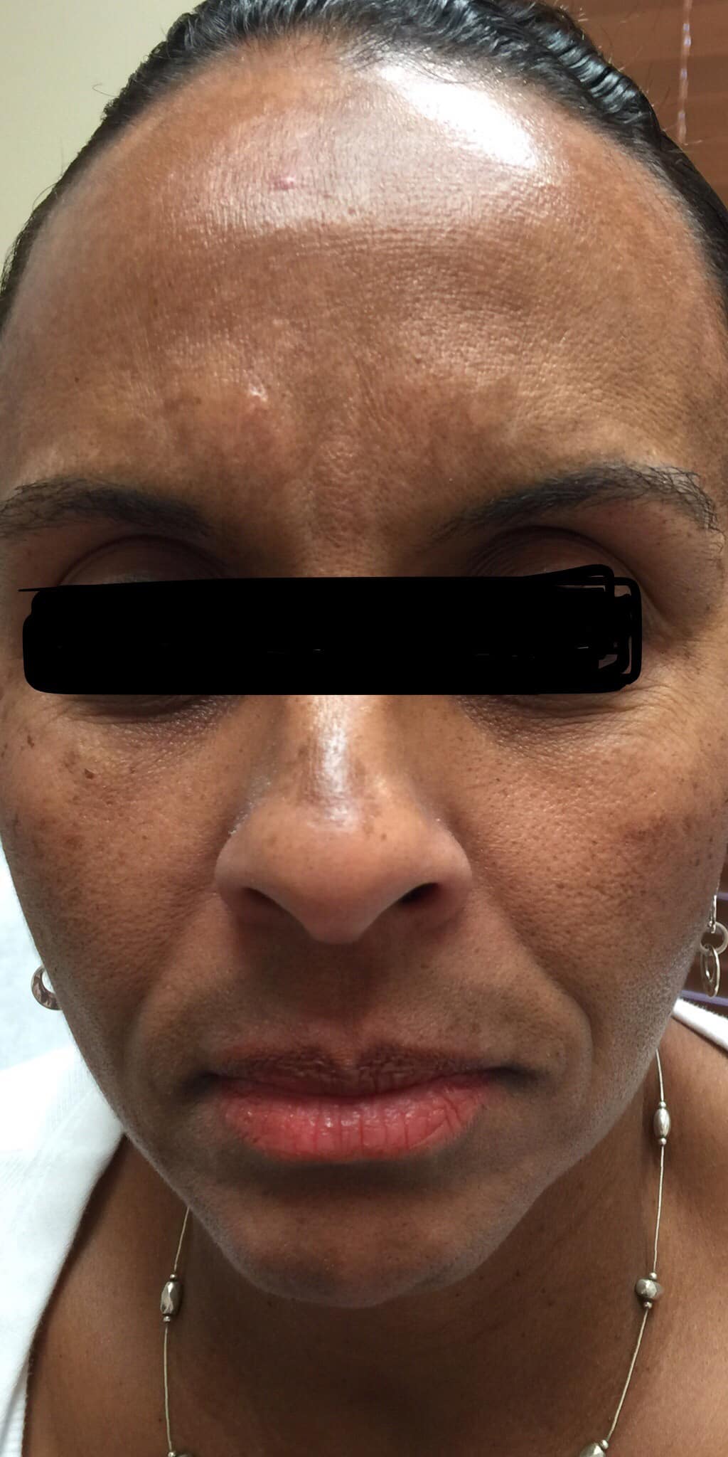 Before Image: Melasma - front