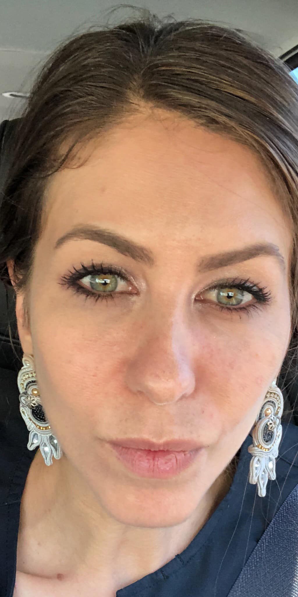 After Image: Sculptra and Filler - front