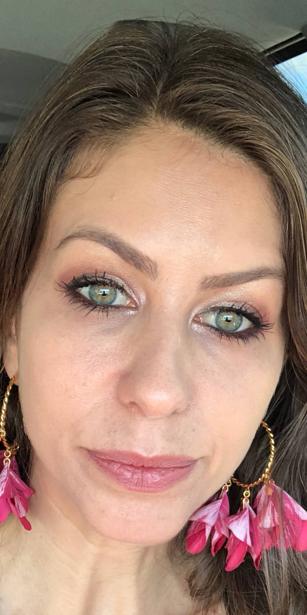 Before Image: Sculptra and Filler - front