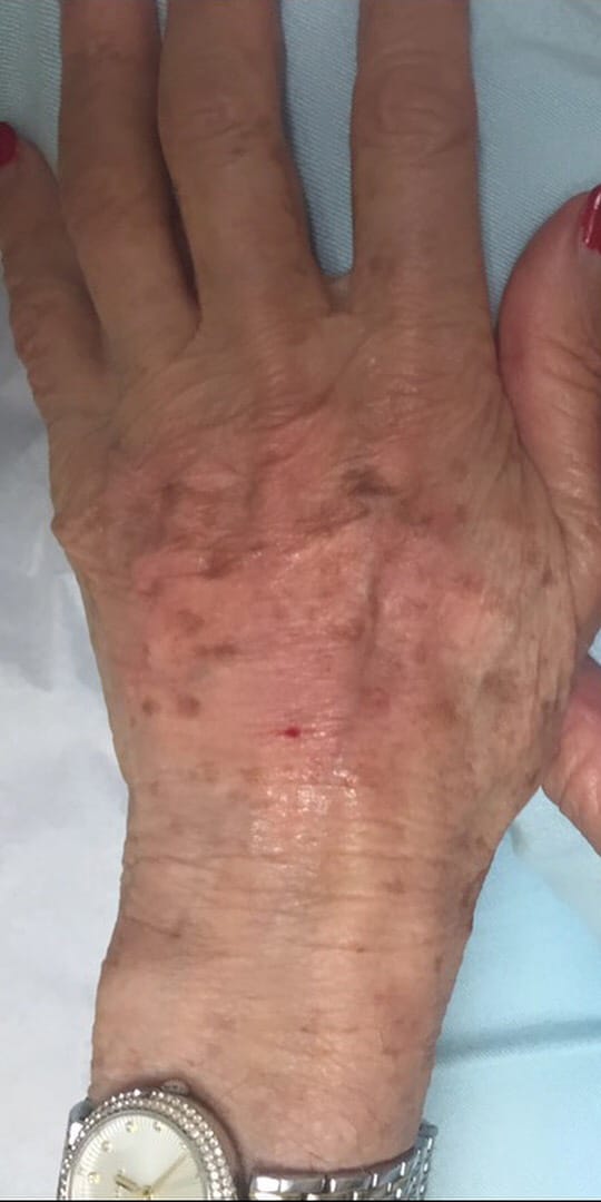 Before Image: Hand Rejuvenation - front