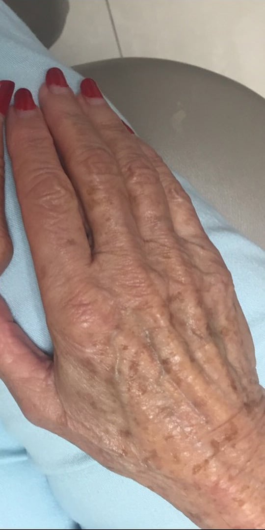 After Image: Hand Rejuvenation - front