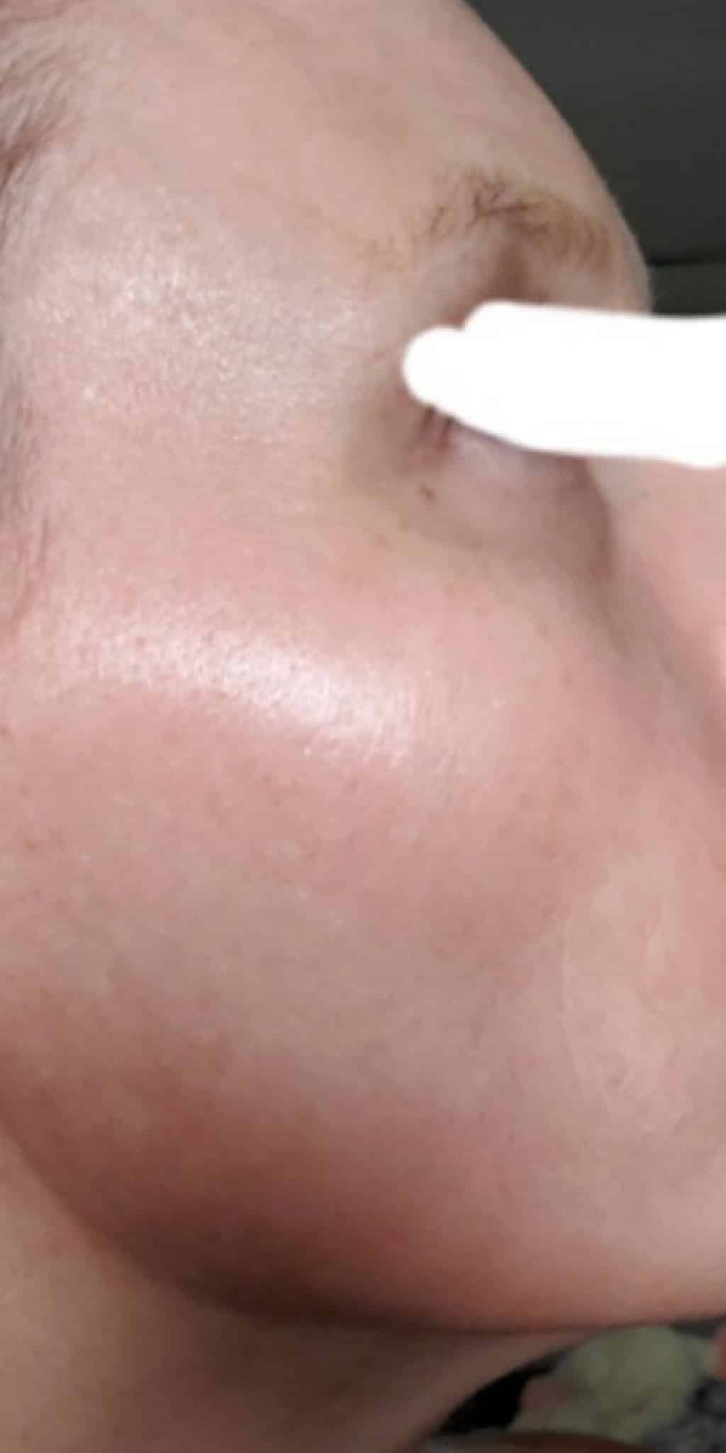 After Image: Lentigines and Brown Spots - front