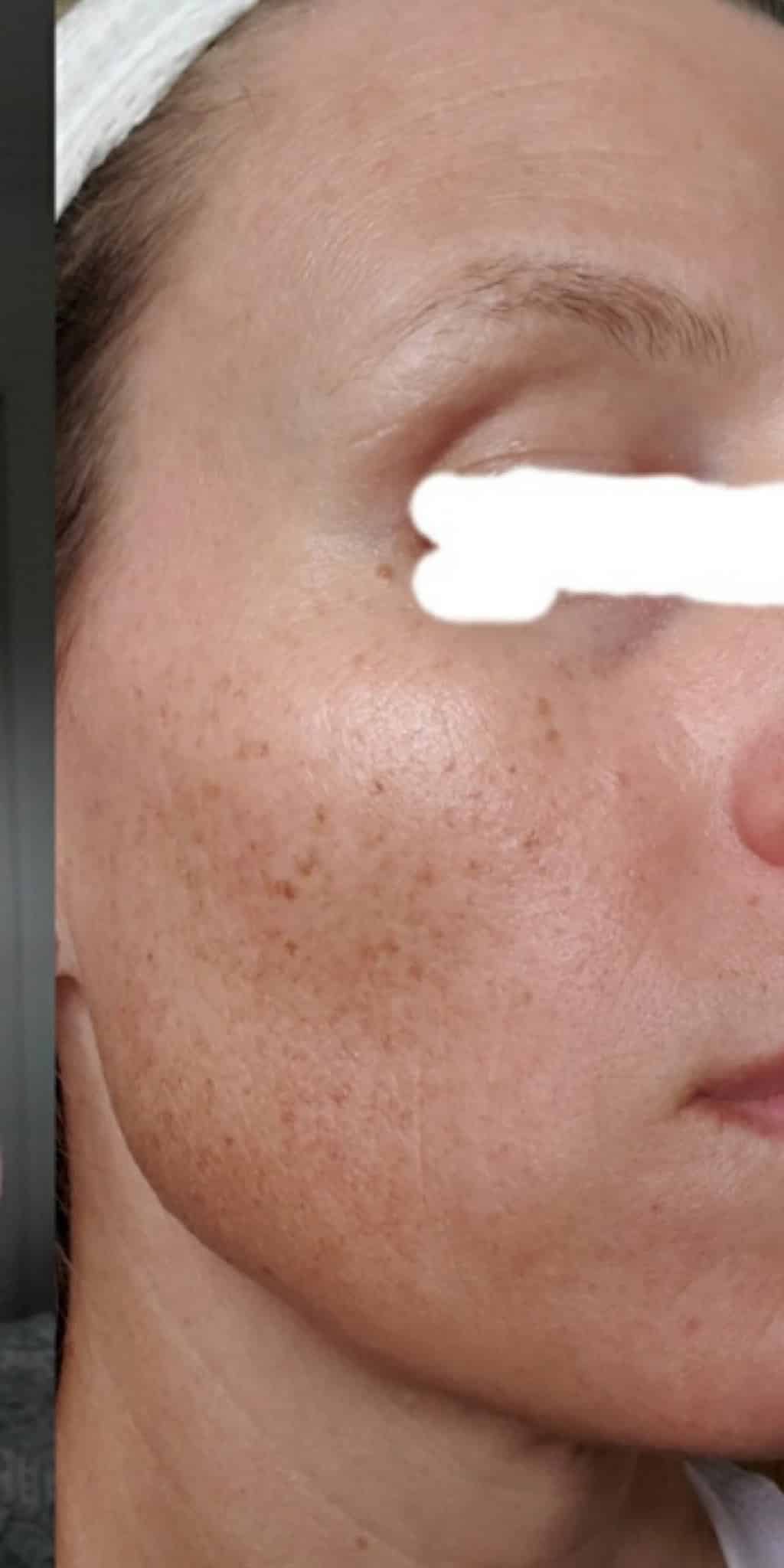Before Image: Lentigines and Brown Spots - front