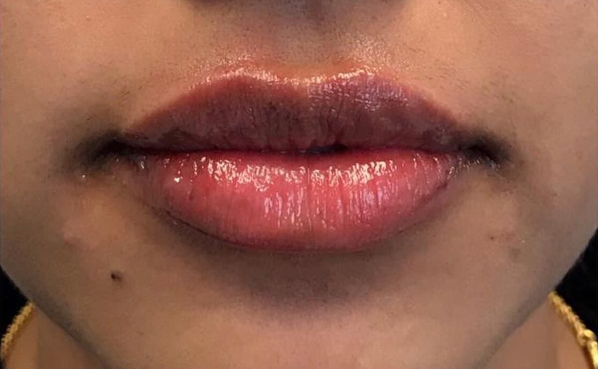 After Image: Lip Filler - front