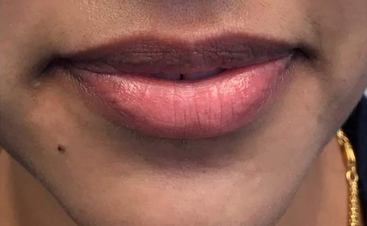 Before Image: Lip Filler - front
