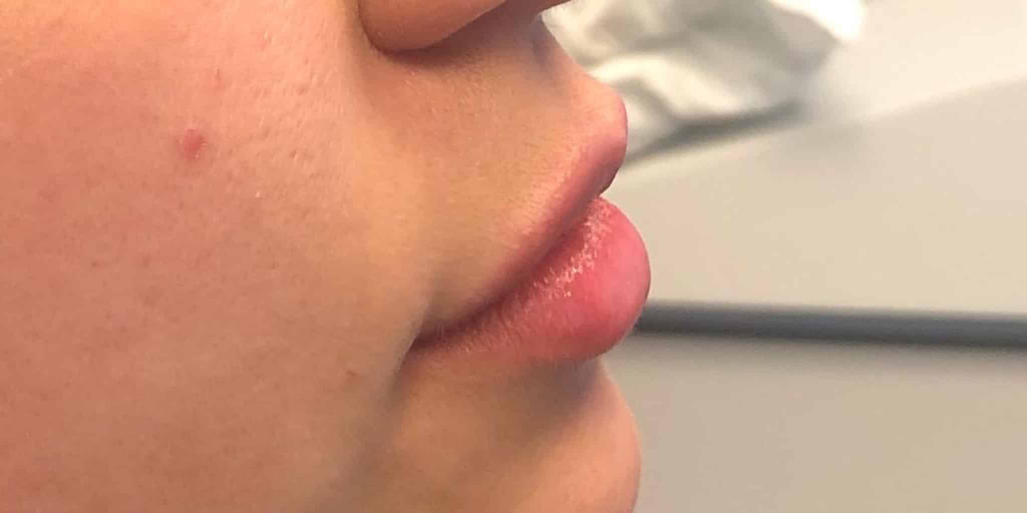 After Image: Lip Hydration - right-side
