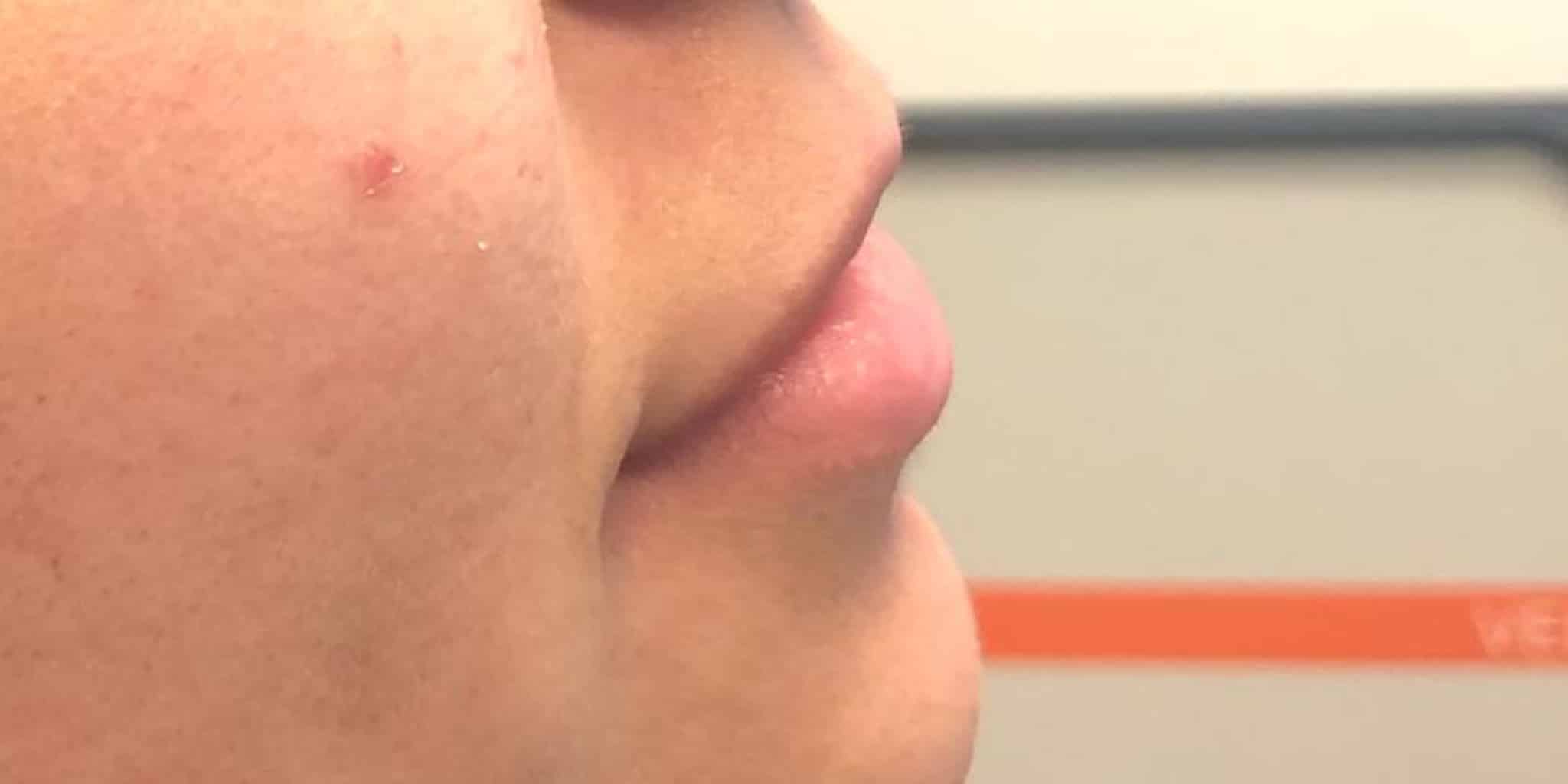 Before Image: Lip Hydration - right-side