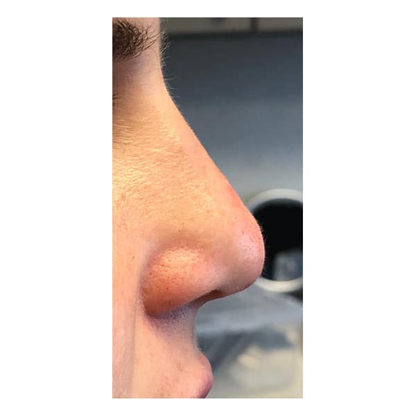 After Image: Nasal Tip Remodeling - right-side