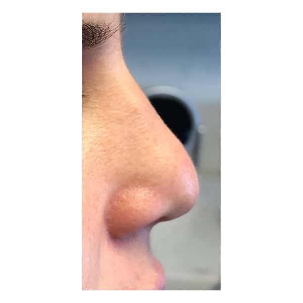 Before Image: Nasal Tip Remodeling - right-side