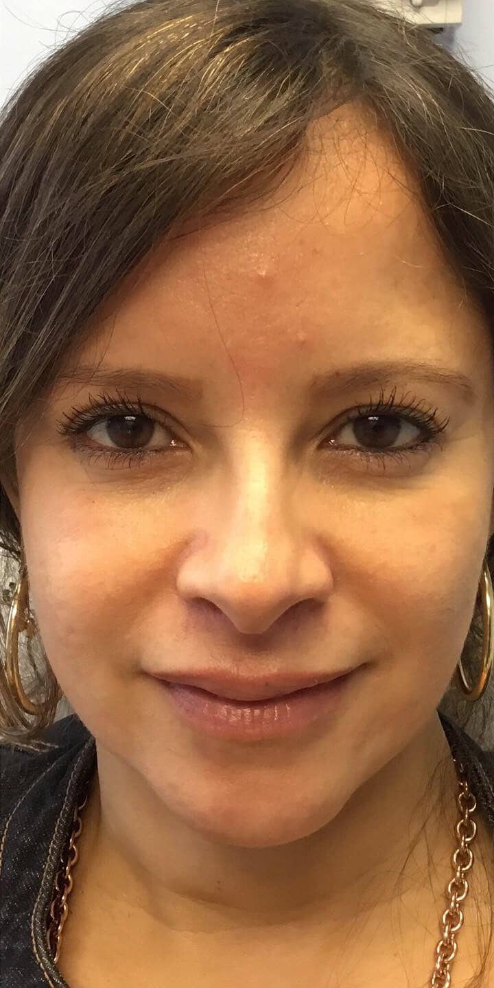 After Image: Panfacial Rejuvenation - front