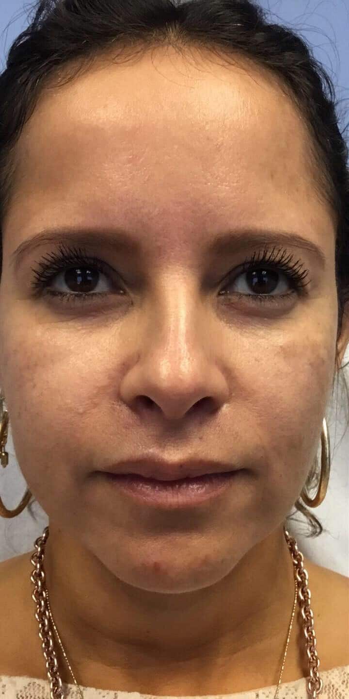 Before Image: Panfacial Rejuvenation - front