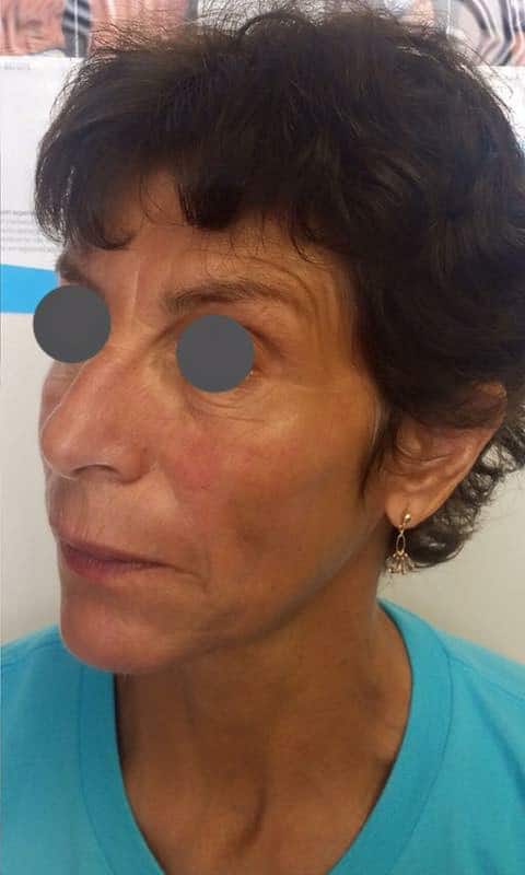 After Image: Panfacial Rejuvenation - left-front-oblique