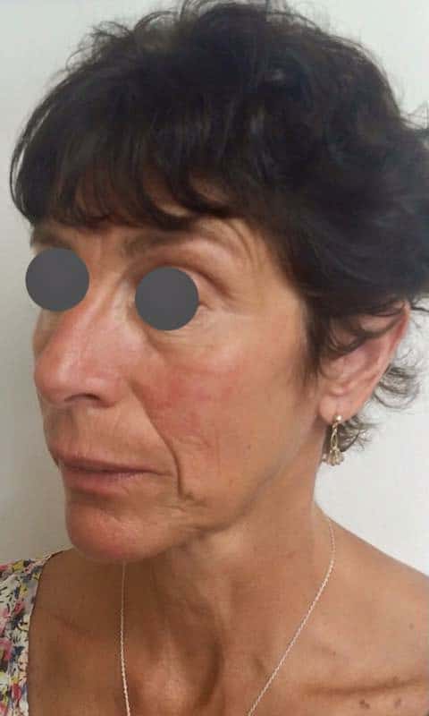 Before Image: Panfacial Rejuvenation - left-front-oblique