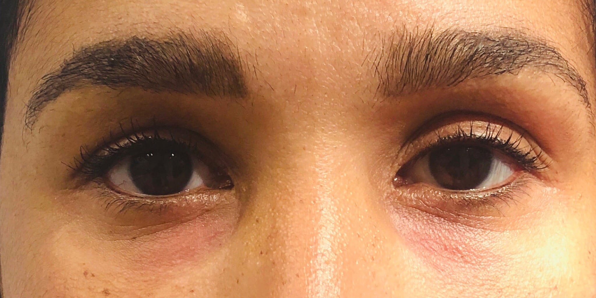 After Image: Undereye Treatment - front