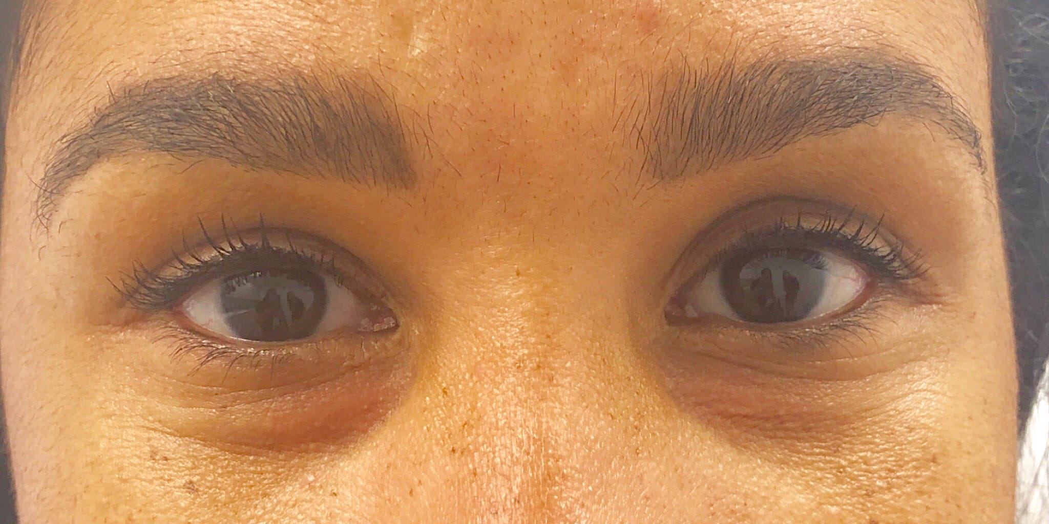 Before Image: Undereye Treatment - front