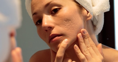 Model in a white headband examining acne scarring on her cheek