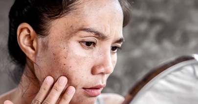 Model with sun spots across her cheek examining her skin in a hand mirror