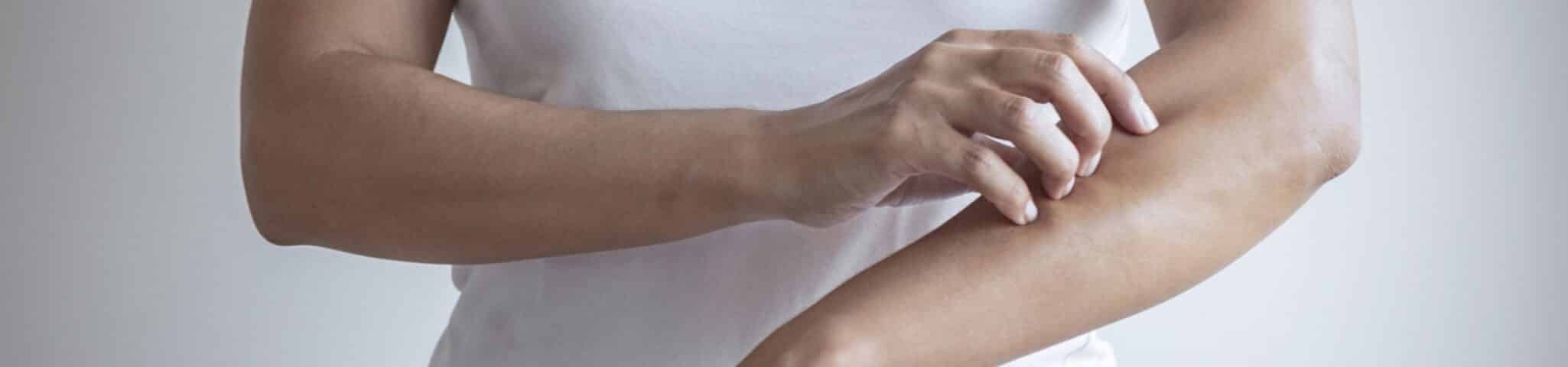 psoriasis treatment aventura FL
